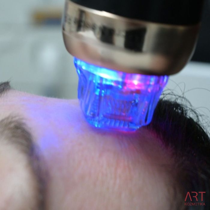 FaceART perfect - napredna tehnologija za nego obraza - microneedling +RF + vacuum