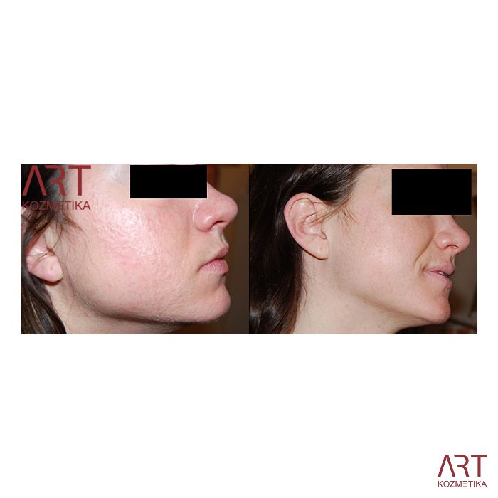 Beauty derma roler - AKCIJA