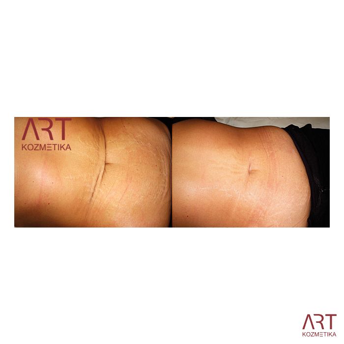 Beauty derma roler - AKCIJA