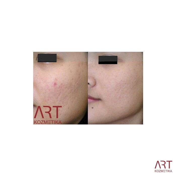 Beauty derma roler - AKCIJA