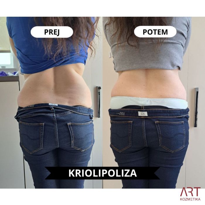 Kriolipoliza CrioART 360