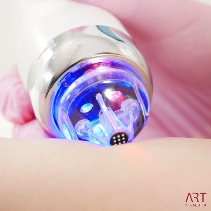 FaceART perfect - napredna tehnologija za nego obraza - microneedling +RF + vacuum