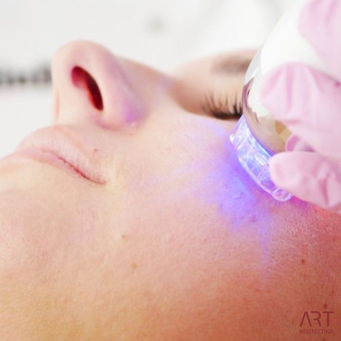 FaceART perfect - napredna tehnologija za nego obraza - microneedling +RF + vacuum