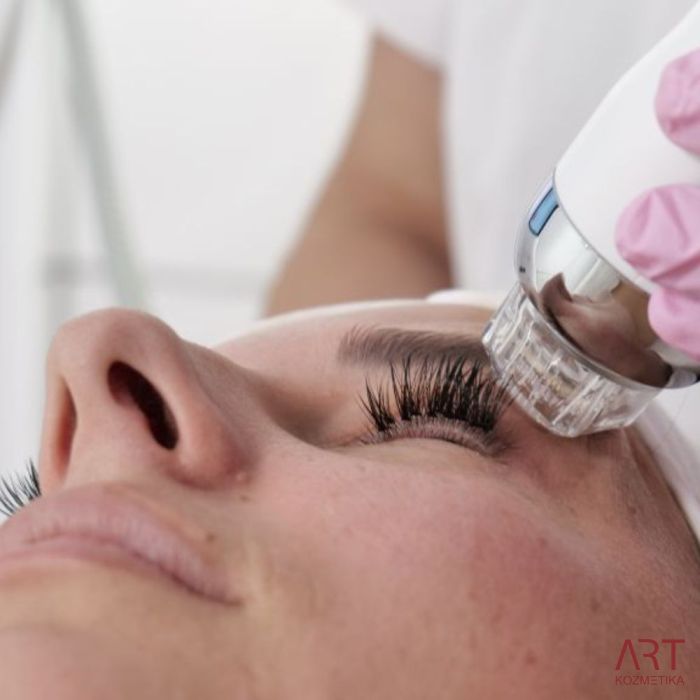 FaceART perfect - napredna tehnologija za nego obraza - microneedling +RF + vacuum