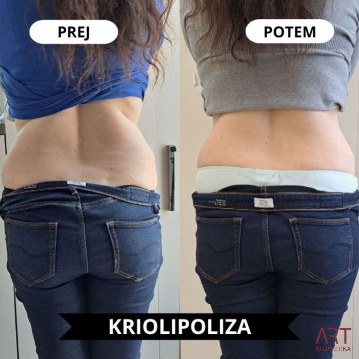 Kriolipoliza CrioART+