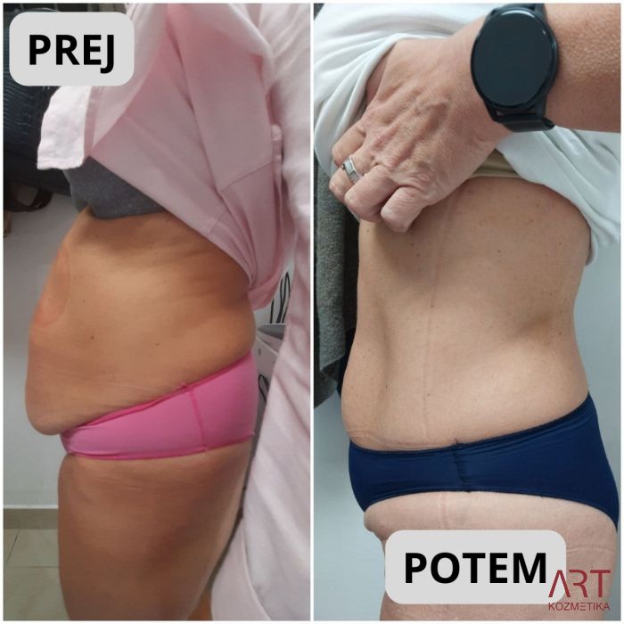 Kriolipoliza CrioART+