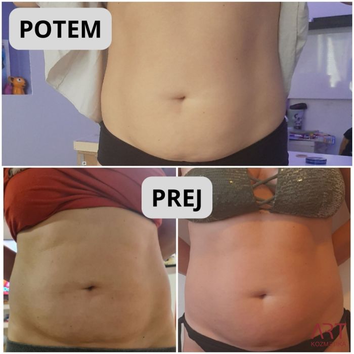 Kriolipoliza CrioART 360