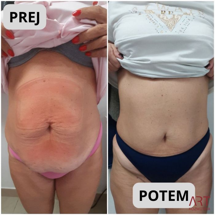 Kriolipoliza CrioART 360