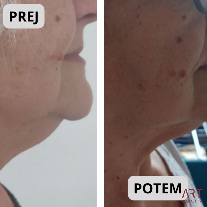 Kriolipoliza CrioART+