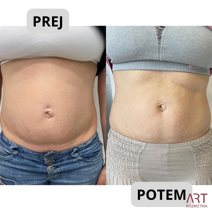 Kriolipoliza CrioART+