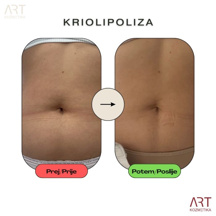 Kriolipoliza CrioART+