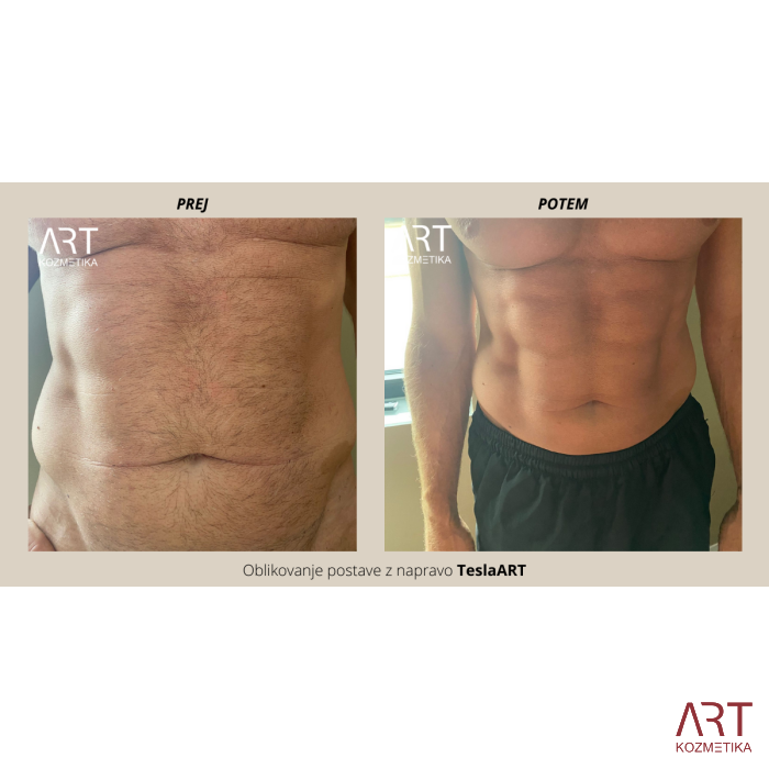 Elektromagnetna stimulacijska naprava TeslaART - prenosni mišični stimulator za oblikovanje telesa