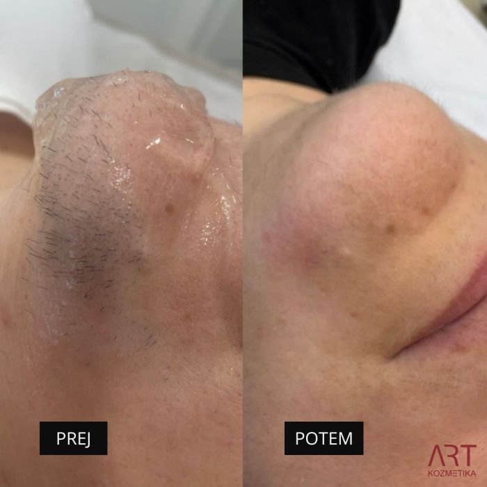 Diodni laser TrisCAM