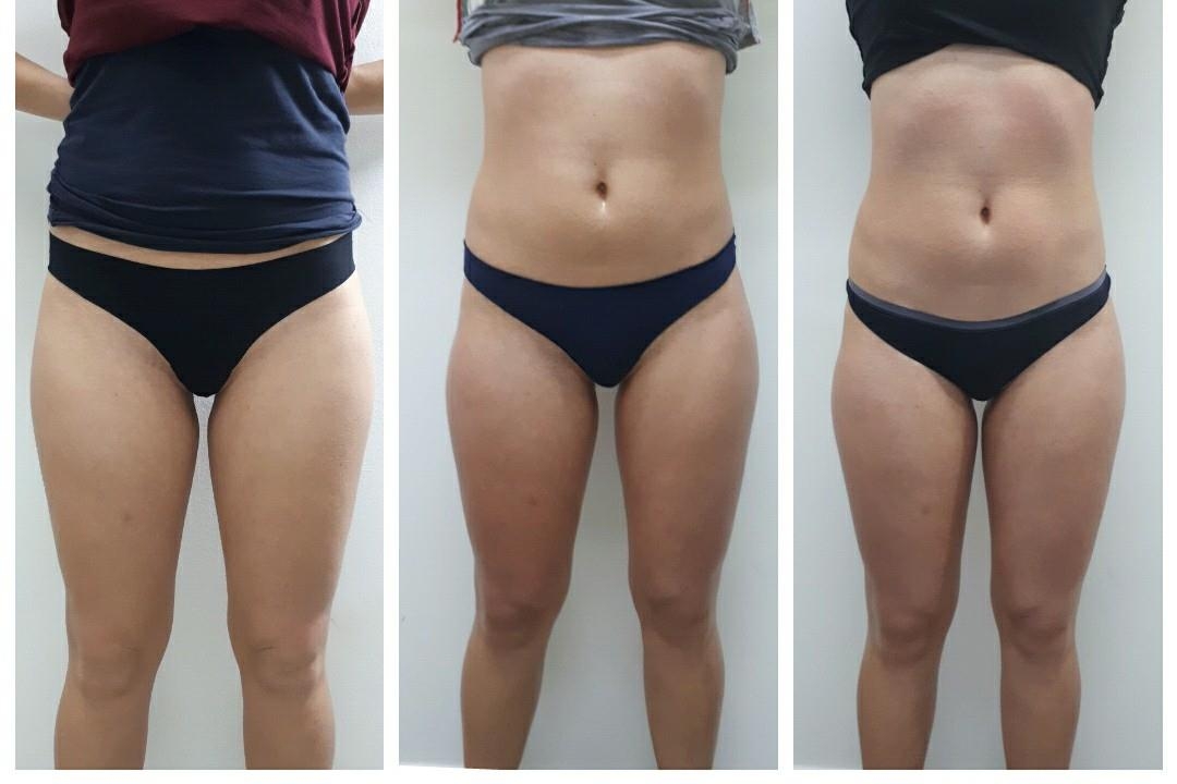 shape art tretma - prej potem shape art tretma - prej potem