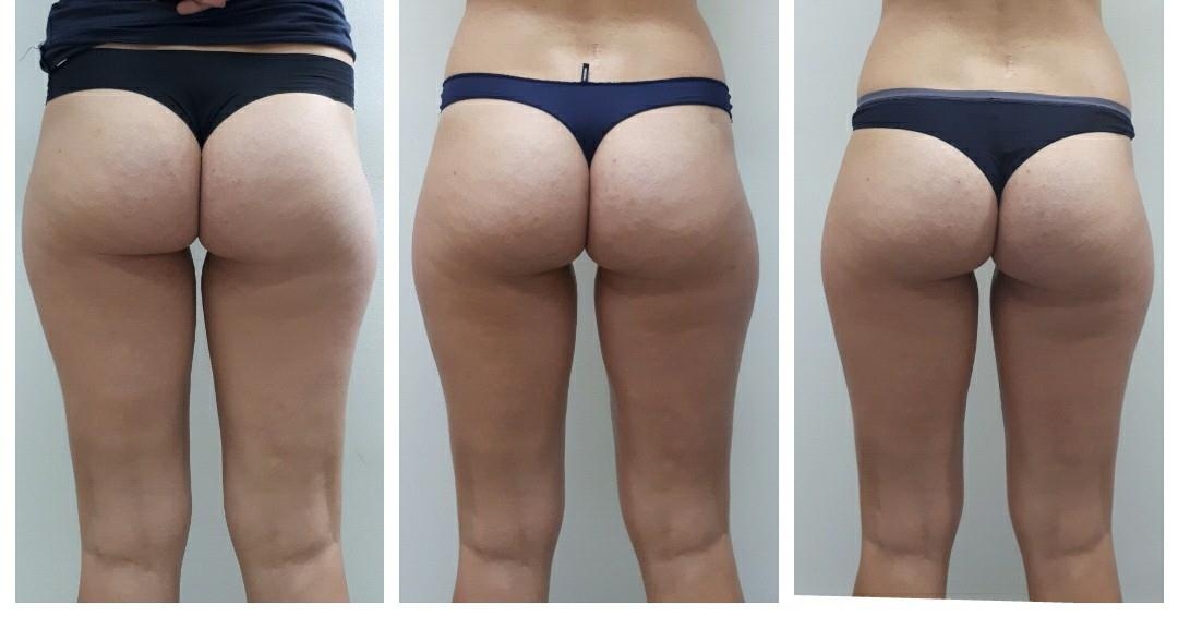 shape art tretma - prej potem ShapeART+