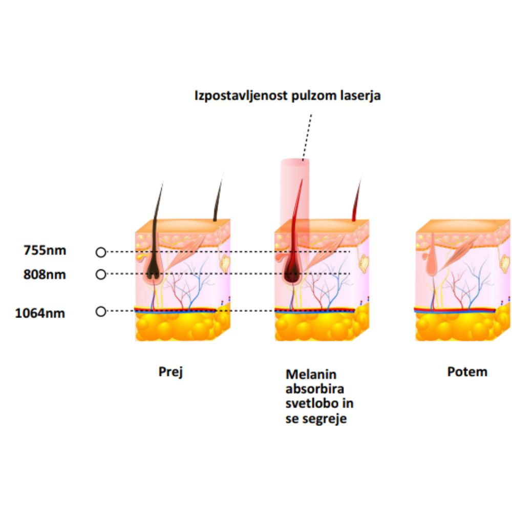 Diodni laser TrisCAM III izpsoatvljenost laserju -impulzi