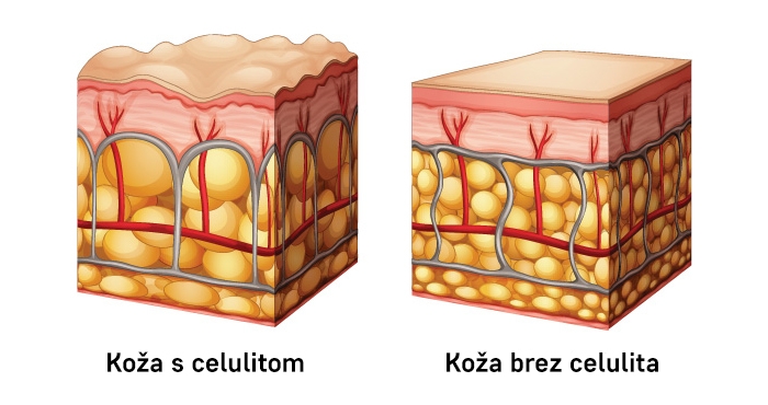 Celulitne celice Celulitne celice