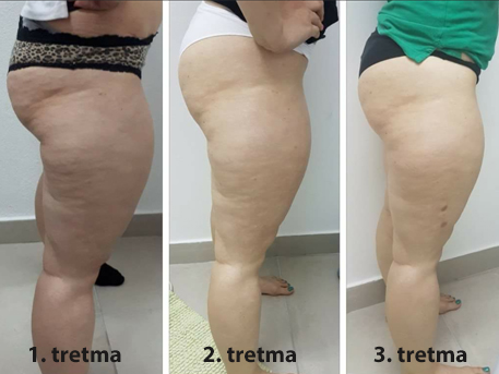 rezultati po tretmajih s ShapeART-om rezultati po tretmajih s ShapeART-om